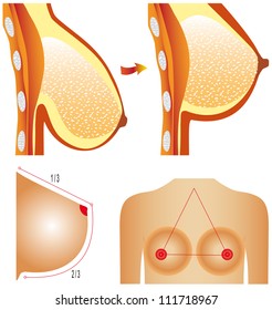 Plastic surgery of breast. Tits correction. Plastic surgery shows breast correction methods on white background.