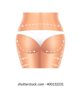 Plastic surgery buttocks and legs isolated on white photo-realistic vector illustration