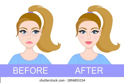 Plastic surgery of eyelids, operation removal of bags under eyes. Blepharoplasty. Beautiful female face before and after. Vector illustration.