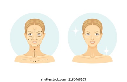 Plastikchirurgie mit weiblichem Gesicht vor und nach der Wiederherstellung und Wiederherstellung im Circle Vector Set