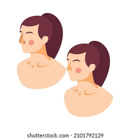 Plastic Surgery Icon With Female Face Before And After Rhinoplasty Operation Isometric Vector Illustration