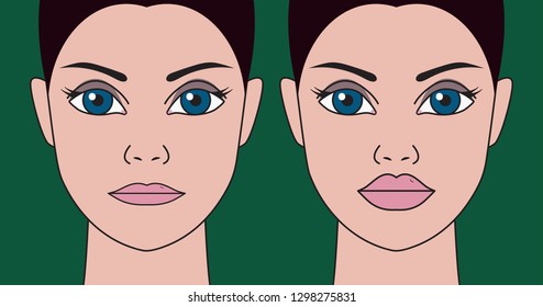 Plastic surgery to increase lips, cheiloplasty. Injections in thin lips, hyaluronic acid, correction of thin lips. Vector illustration before and after