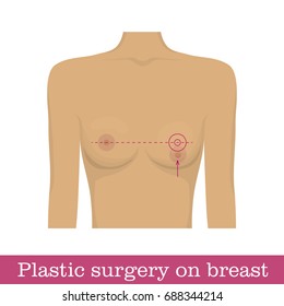Plastic surgery nipple uplift infographic. Scheme of surgical correction of the position of the nipple by uplift method. Correction of position of a mammary gland in the form of a vector illustration