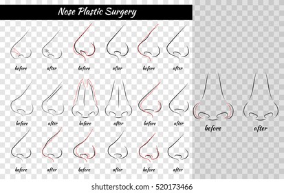 Plastic Surgery. Nose. Vector illustration. Nose Templates. Set of Noses.