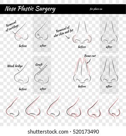 Plastic Surgery. Nose. Vector illustration. Nose Templates. Set of Noses.