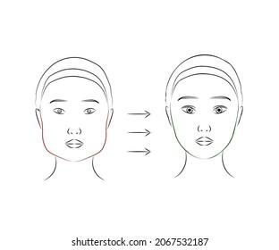 Plastic surgery on a woman's face. Silhouette V - line of the face. Vector illustration.