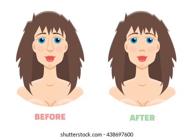 Plastic surgery, rhinoplasty before and after