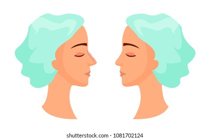 Plastic surgery - rhinoplasty. Reduction of the nose