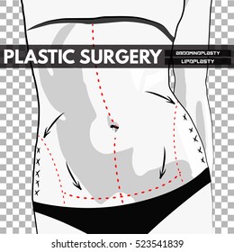 Plastic Surgery. Vector Illustration.