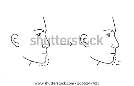 Plastic surgery of young man protruding chin to reshape before and after chart. Line minimalist style drawing.