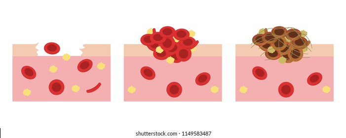 Platelet And Fibrin On Wound Vector
