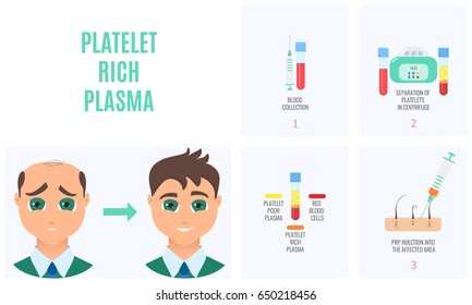 Platelet rich plasma injection procedure. PRP therapy process for men. Male hair loss treatment infographics. Hair regrowth stimulation method. Vector illustration.
