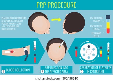 Platelet rich plasma injection. PRP therapy process. Male baldness treatment infographics.  Meso therapy. Hair growth stimulation. Vector illustration.