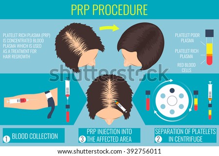 Platelet rich plasma injection. PRP therapy process. Female alopecia treatment infographics. Meso therapy and hair growth stimulation. Vector illustration.