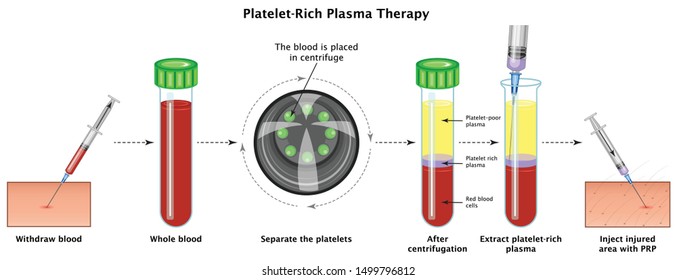 Platelet Rich Plasma Procedure Stages. Concept PRP Separate Inject 
Withdraw Blood Whole Blood Separate the Platelets After Gentrifugation Extract PRP and Inject Medical Education Vector Illustration