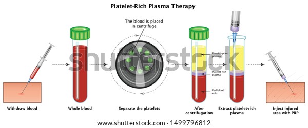 Platelet Rich Plasma Procedure Stages.
Concept PRP Separate Inject 
Withdraw Blood Whole Blood Separate
the Platelets After Gentrifugation Extract PRP and Inject Medical
Education Vector
Illustration