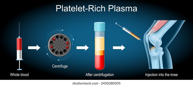 Platelet-rich plasma procedure. Osteoarthritis treatment. Syringe and Human knee joint with inflammation. PRP injection. therapy of joint pain. Regenerative medicine for joint tissue repair