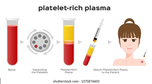 Platelet-Rich Plasma Procedure Stages / Prp / Centrifuge Vector