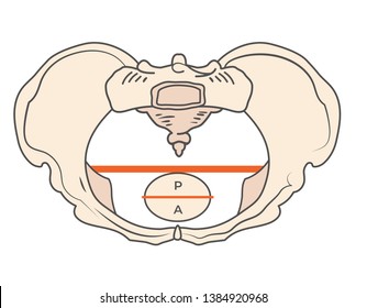 Platypoid / Platypelloid Pelvis Shape with Round or Circular shape