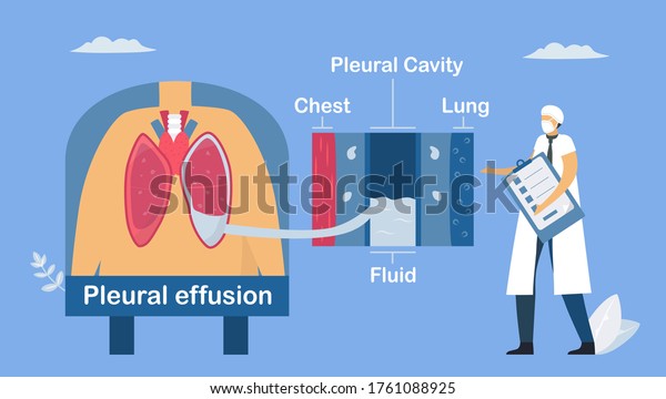 Pleural Effusion Collection Excess Fluid Between Stock Vector Royalty