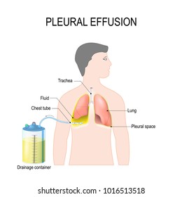 Pleural Effusion High Res Stock Images Shutterstock