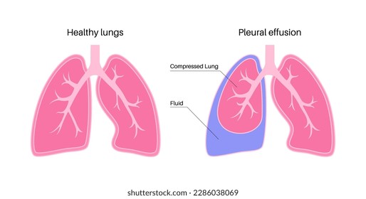 Pleural effusion disease. Fluid between the layers of tissue in lungs and chest cavity. DIfficult breathing. Unhealthy internal organs in the human body. Respiratory system medical vector illustration