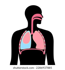 Pleural effusion disease. Fluid between the layers of tissue in lungs and chest cavity. DIfficult breathing. Unhealthy internal organs in the human body. Respiratory system medical vector illustration