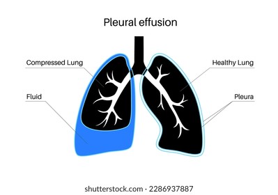 Pleural effusion disease. Fluid between the layers of tissue in lungs and chest cavity. DIfficult breathing. Unhealthy internal organs in the human body. Respiratory system medical vector illustration