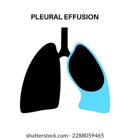 Pleural effusion disease. Fluid between the layers of tissue in lungs and chest cavity. DIfficult breathing. Unhealthy internal organs in the human body. Respiratory system medical vector illustration