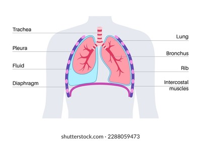 Pleural effusion disease. Fluid between the layers of tissue in lungs and chest cavity. DIfficult breathing. Unhealthy internal organs in the human body. Respiratory system medical vector illustration