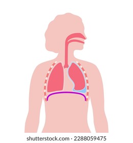 Enfermedad por derrame pleural. Fluido entre las capas de tejido en los pulmones y la cavidad torácica. Es difícil respirar. Órganos internos poco saludables en el cuerpo humano. Ilustración del vector médico del sistema respiratorio