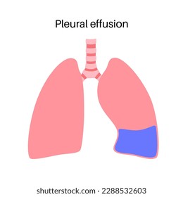 Pleural effusion disease. Fluid between the layers of tissue in lungs and chest cavity. DIfficult breathing. Unhealthy internal organs in the human body. Respiratory system medical vector illustration