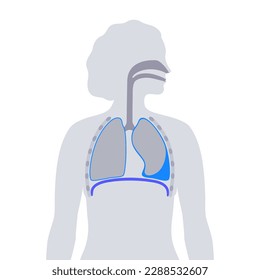 Enfermedad por derrame pleural. Fluido entre las capas de tejido en los pulmones y la cavidad torácica. Es difícil respirar. Órganos internos poco saludables en el cuerpo humano. Ilustración del vector médico del sistema respiratorio