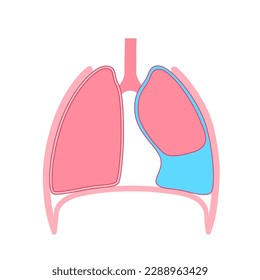 Pleural effusion disease. Fluid between the layers of tissue in lungs and chest cavity. DIfficult breathing. Unhealthy internal organs in the human body. Respiratory system medical vector illustration