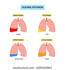 Pleural effusion poster. Fluid between the layers of tissue in lungs and chest cavity. Common lungs diseases. Cough, chest pain, difficulty breathing. Unhealthy internal organs in respiratory system