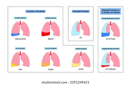 Afiche de derrame pleural. Fluido entre las capas de tejido en los pulmones y la cavidad torácica. Enfermedades pulmonares comunes. Tos, dolor torácico, dificultad para respirar. Órganos internos insalubres en el sistema respiratorio