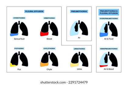 Pleural effusion poster. Fluid between the layers of tissue in lungs and chest cavity. Common lungs diseases. Cough, chest pain, difficulty breathing. Unhealthy internal organs in respiratory system