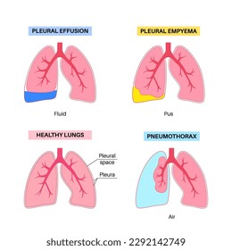 Pleural effusion poster. Fluid between the layers of tissue in lungs and chest cavity. Common lungs diseases. Cough, chest pain, difficulty breathing. Unhealthy internal organs in respiratory system