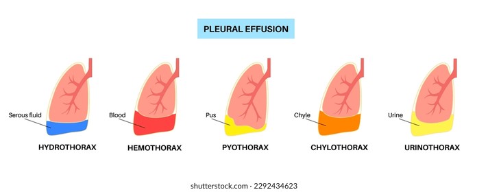 Afiche de derrame pleural. Fluido entre las capas de tejido en los pulmones y la cavidad torácica. Enfermedades pulmonares comunes. Tos, dolor torácico, dificultad para respirar. Órganos internos insalubres en el sistema respiratorio