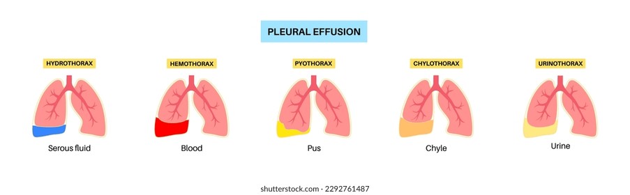 Pleural effusion poster. Fluid between the layers of tissue in lungs and chest cavity. Common lungs diseases. Cough, chest pain, difficulty breathing. Unhealthy internal organs in respiratory system