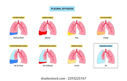 Afiche de derrame pleural. Fluido entre las capas de tejido en los pulmones y la cavidad torácica. Enfermedades pulmonares comunes. Tos, dolor torácico, dificultad para respirar. Órganos internos insalubres en el sistema respiratorio