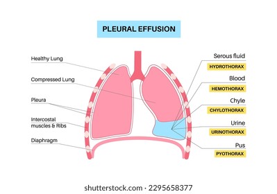 Afiche de derrame pleural. Fluido entre las capas de tejido en los pulmones y la cavidad torácica. Enfermedades pulmonares comunes. Tos, dolor torácico, dificultad para respirar. Órganos internos insalubres en el sistema respiratorio