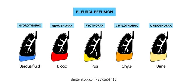 Afiche de derrame pleural. Fluido entre las capas de tejido en los pulmones y la cavidad torácica. Enfermedades pulmonares comunes. Tos, dolor torácico, dificultad para respirar. Órganos internos insalubres en el sistema respiratorio