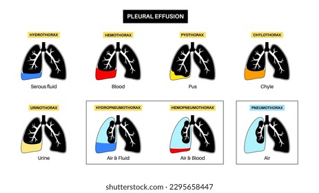 Pleural effusion poster. Fluid between the layers of tissue in lungs and chest cavity. Common lungs diseases. Cough, chest pain, difficulty breathing. Unhealthy internal organs in respiratory system