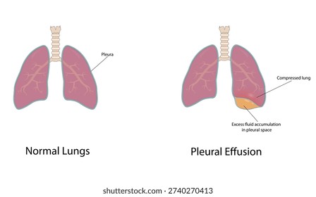 Pleural effusion vector illustration. Lungs