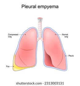 Pleural empyema. Normal lung and lungs after accumulation of pus within the pleural cavity. Vector illustration