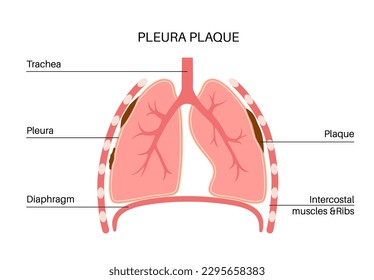 Pleural plaque medical poster. Asbestos related lungs disease. Thickened tissue in the human body, respiratory system illness. Difficulty breathing, bloody cough, chest pain flat vector illustration.