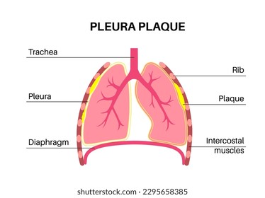 Pleural plaque medical poster. Asbestos related lungs disease. Thickened tissue in the human body, respiratory system illness. Difficulty breathing, bloody cough, chest pain flat vector illustration.