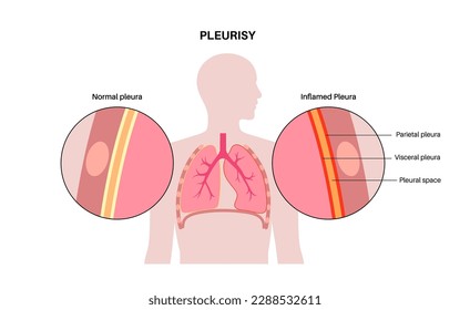 Pleurisy disease concept. Inflammation in lungs. Sharp chest pain during breathing. Unhealthy internal organs in the human body. Chest cavity problem. Respiratory system poster vector illustration.