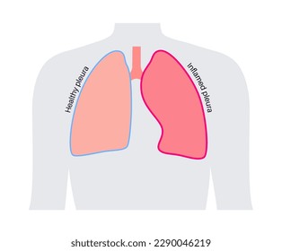 Pleurisy disease concept. Inflammation in lungs. Sharp chest pain during breathing. Unhealthy internal organs in the human body. Chest cavity problem. Respiratory system poster vector illustration.